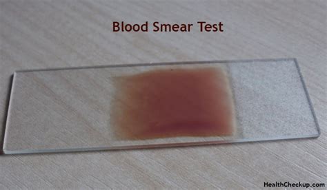 Peripheral Blood Smear Test Purpose, Procedure, .